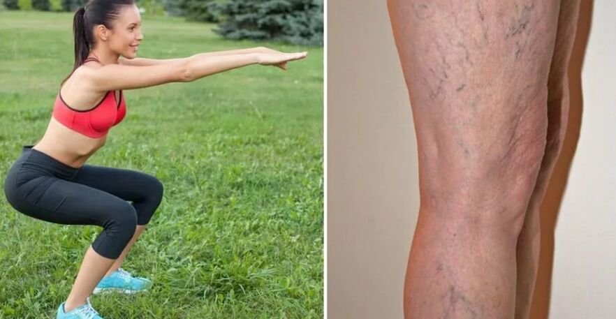 Jambes pour les varices