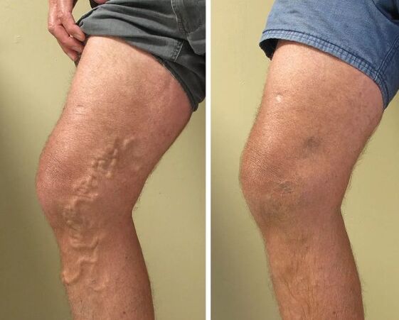 Varices veines avant et après le traitement