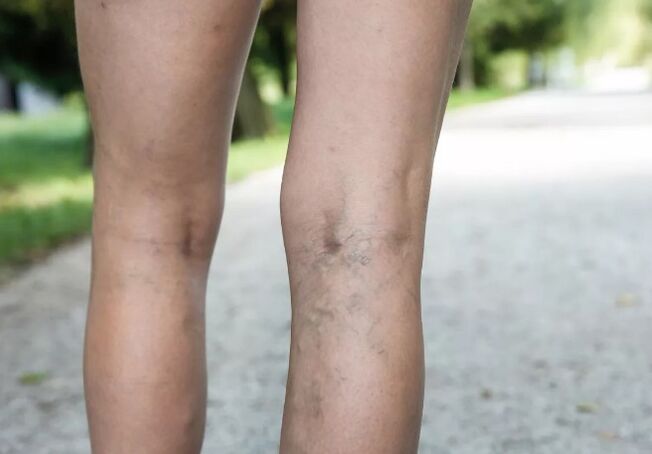 Varices